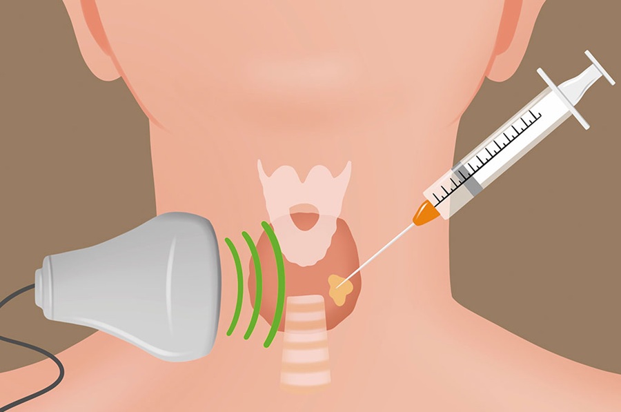 Tiroid Nodüllerinde Kesin Tanı: Ultrason Eşliğinde İnce İğne Biyopsisi